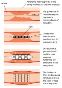 Coronary Angioplasty